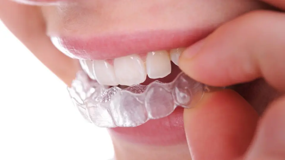 Invisalign Special Offer Featured Image - Marx Family Dental