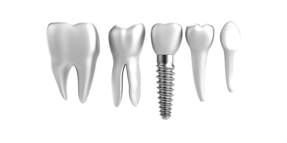 Candidates Mini Dental Implants Featured Image - Marx Family Dental
