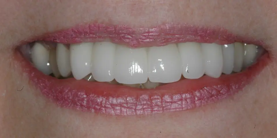 Dental Implants with Crowns Image 01 - Marx Family Dental