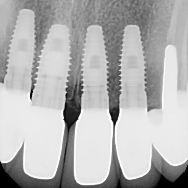 Dental Implants with Crowns Image 02 - Marx Family Dental