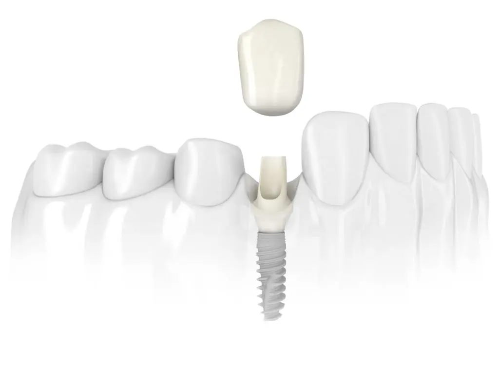 Dental Implant Questions and Answers Image - Marx Family Dental