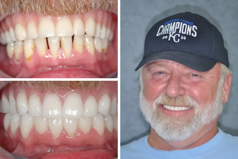 Dental Orthodontic Treatment | Marx Family Dental