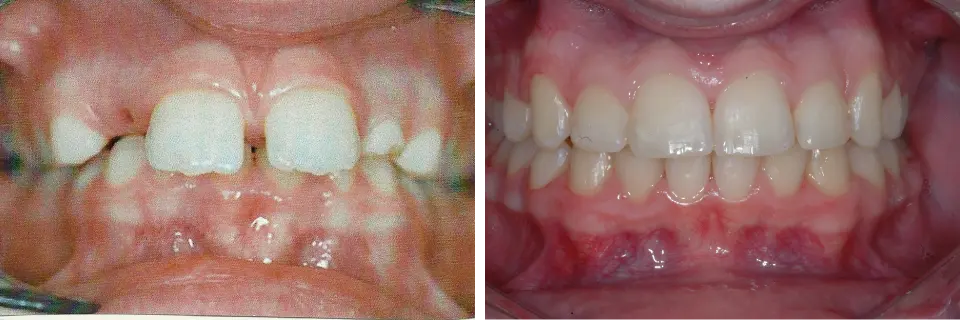 Orthodontics Before After Image 01 - Marx Family Dental