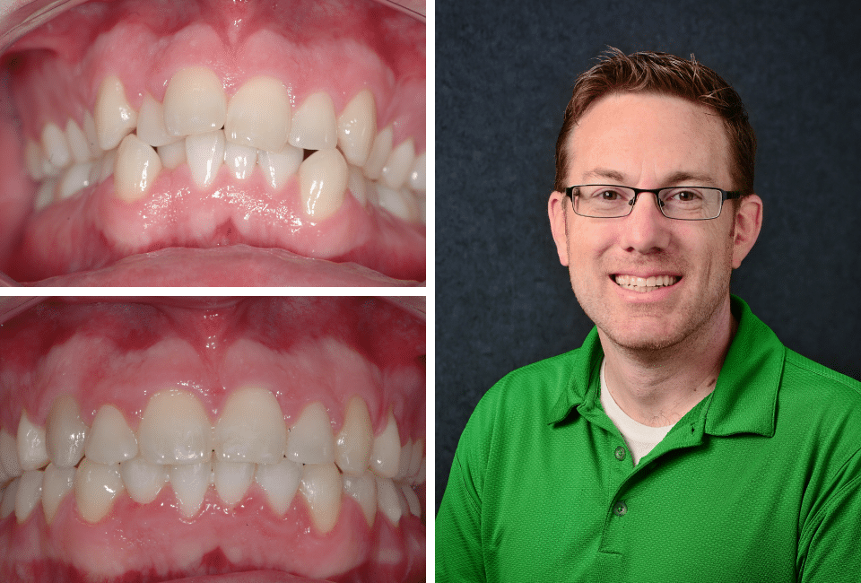 Orthodontics Before After Image Quinn - Marx Family Dental