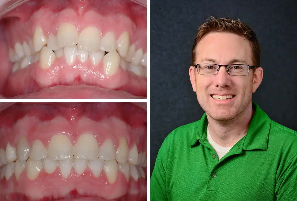 Orthodontics Before After Image Quinn - Marx Family Dental