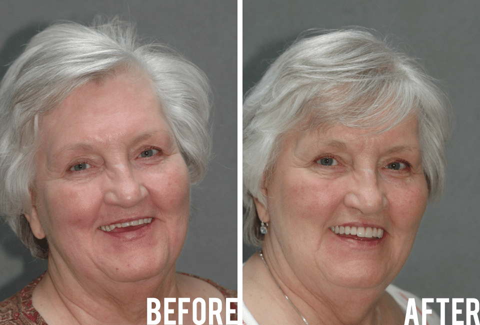 Connie Before After Image - Marx Family Dental