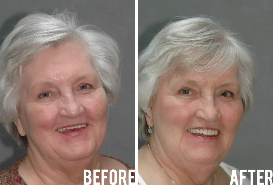 Connie Before After Image - Marx Family Dental