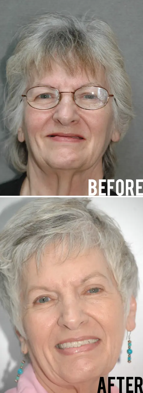 Full Mouth Restoration Before After Image - Marx Family Dental