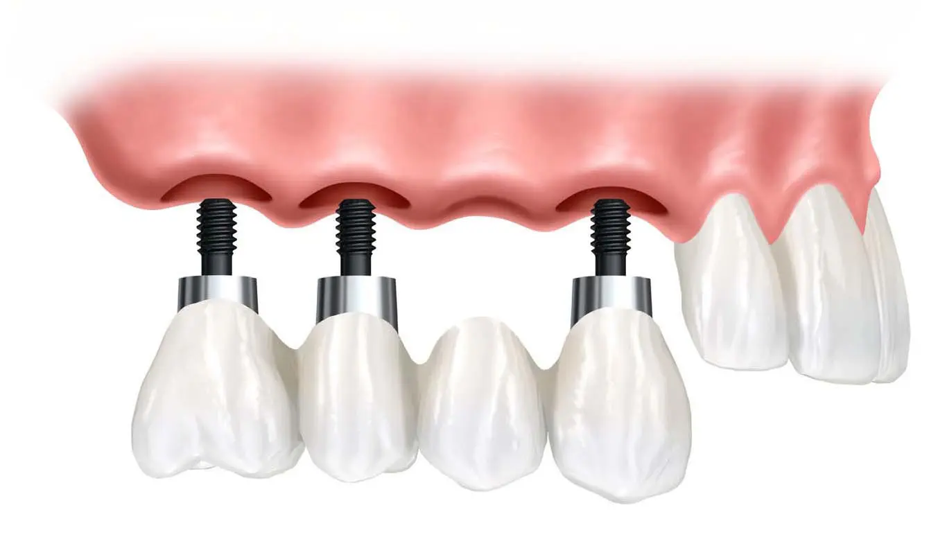 Dental Implant Supported Bridge Image - Marx Family Dental