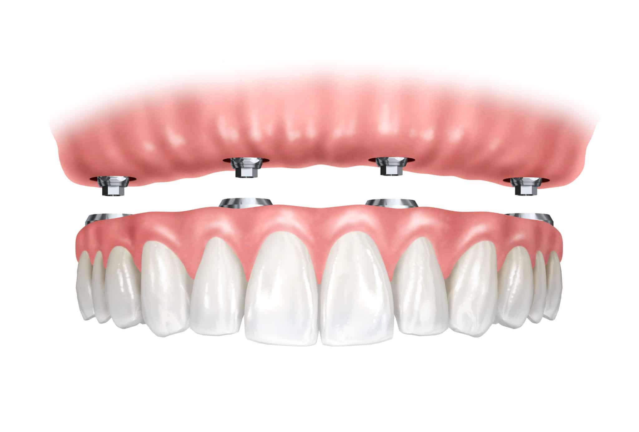 Dental Implant Supported Denture Image - Marx Family Dental