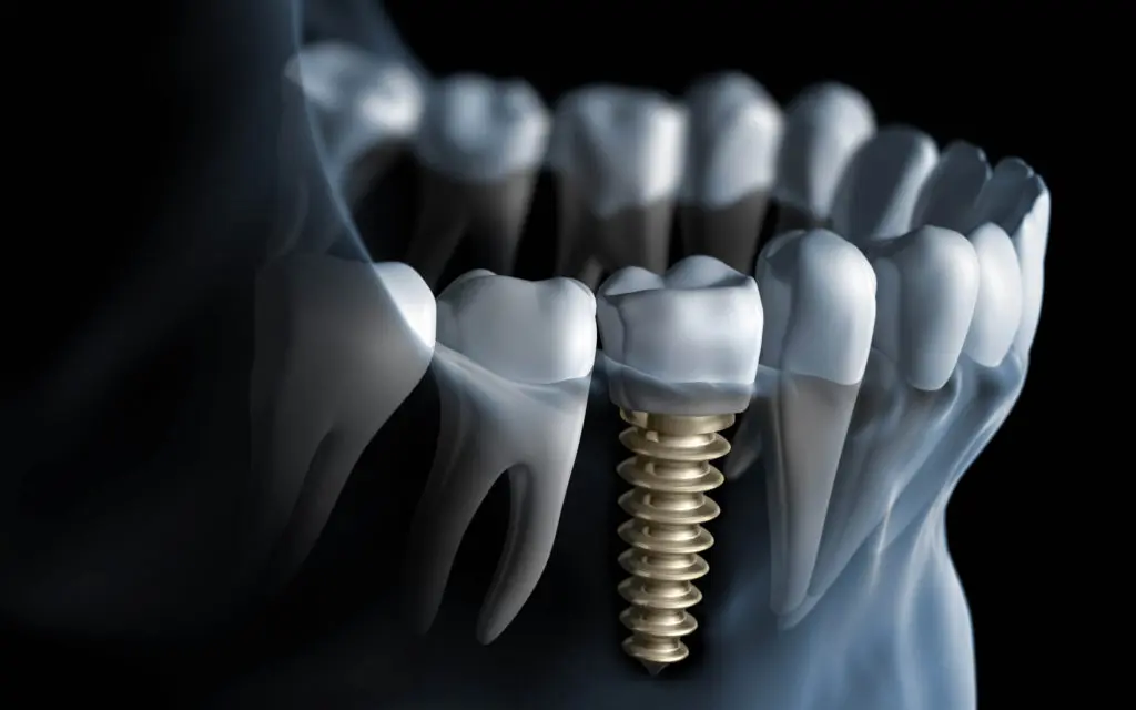 Dental Implants In Kansas City Featured Image - Marx Family Dental