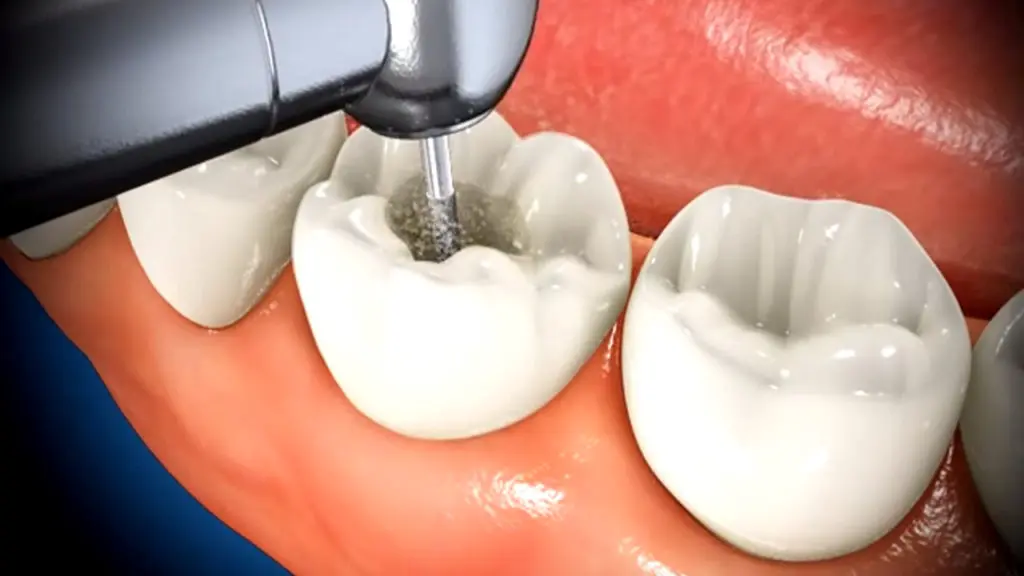 What To Expect When Getting A Root Canal Featured Image - Marx Family Dental