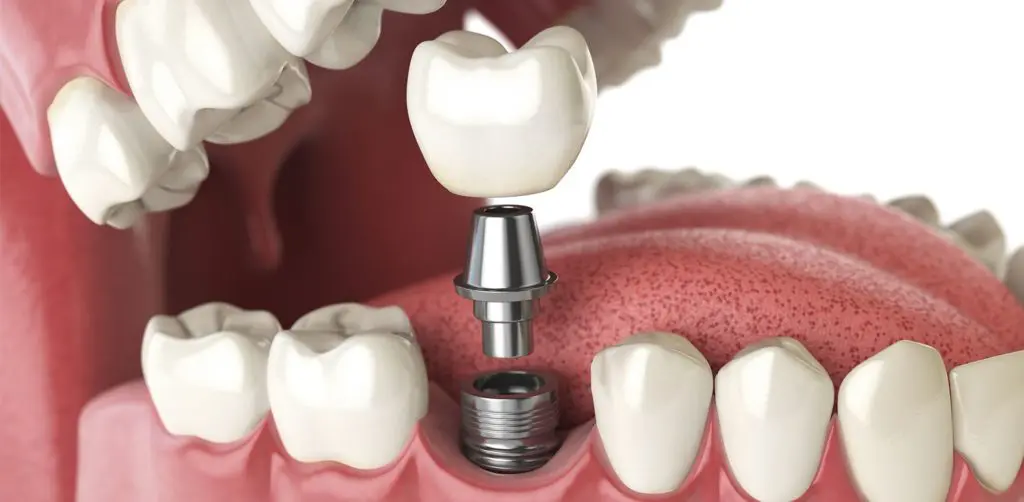 What To Expect With Dental Implant Surgery Featured Image - Marx Family Dental