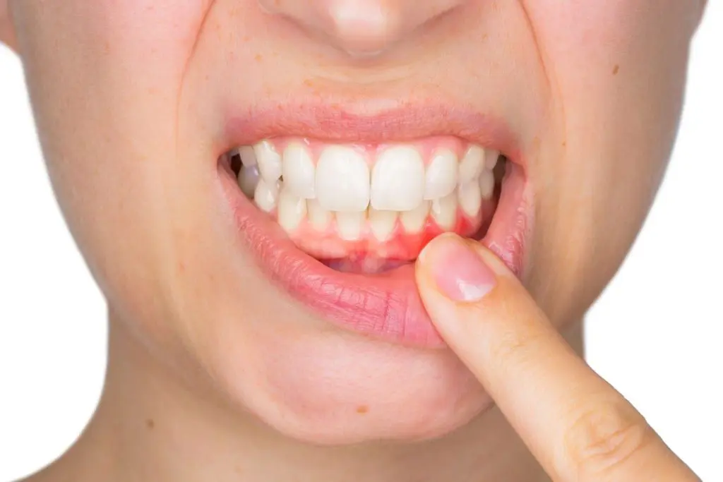 Five Reasons To Treat Gum Disease Featured Image - Marx Family Dental