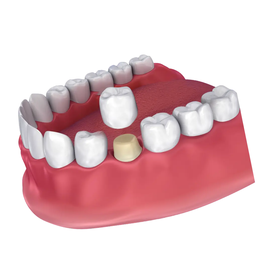 Common Questions About Dental Crowns Featured Image - Marx Family Dental