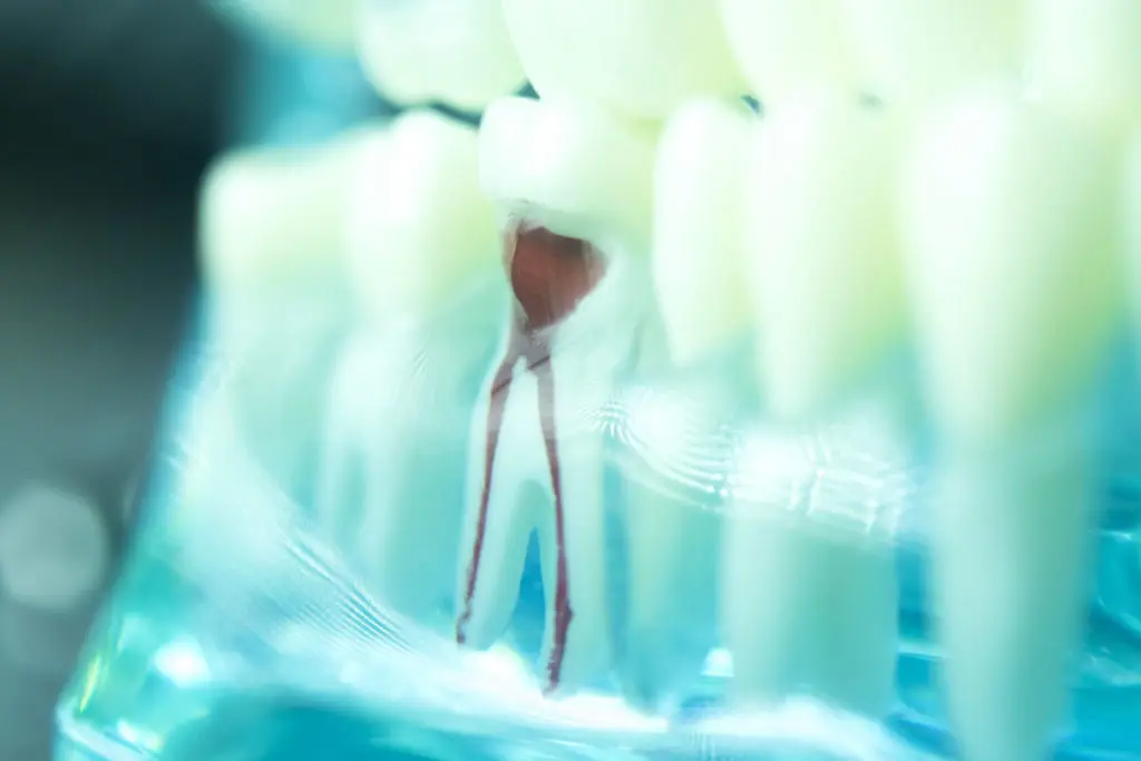 Root Canal Therapy Might Just Save Your Tooth Featured Image - Marx Family Dental