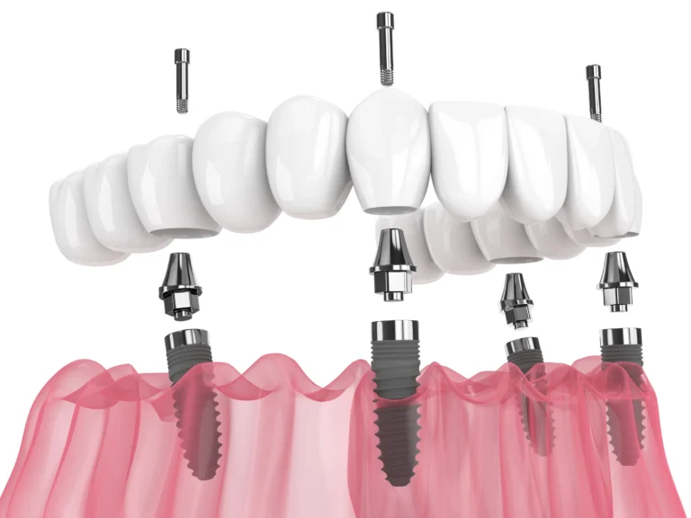 An illustration of a fixed full-arch bridge attached to implants