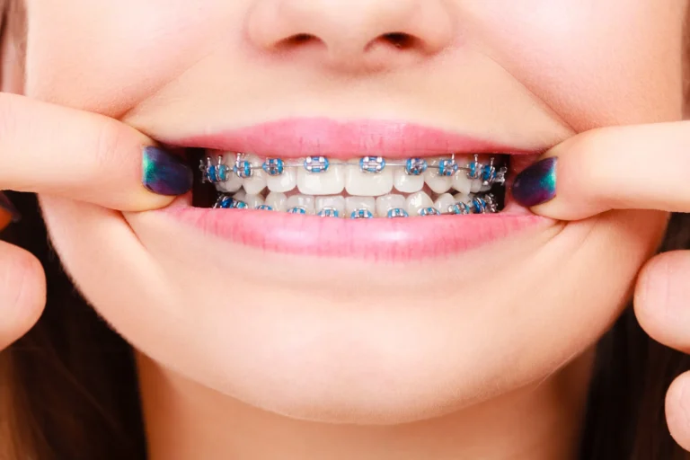 A close-up of a smile with metal braces