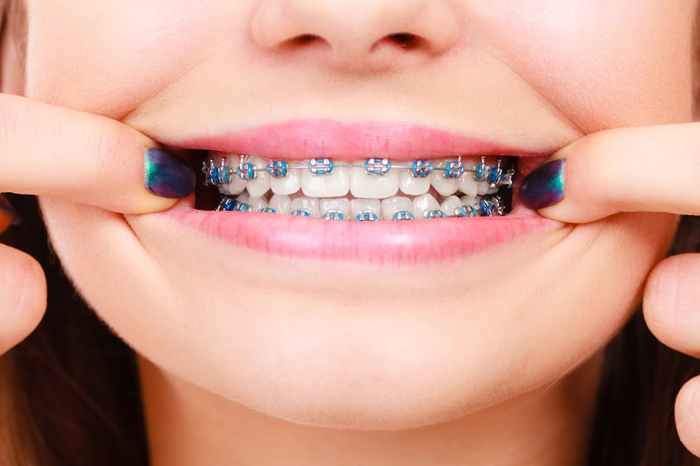 A close-up of a smile with metal braces
