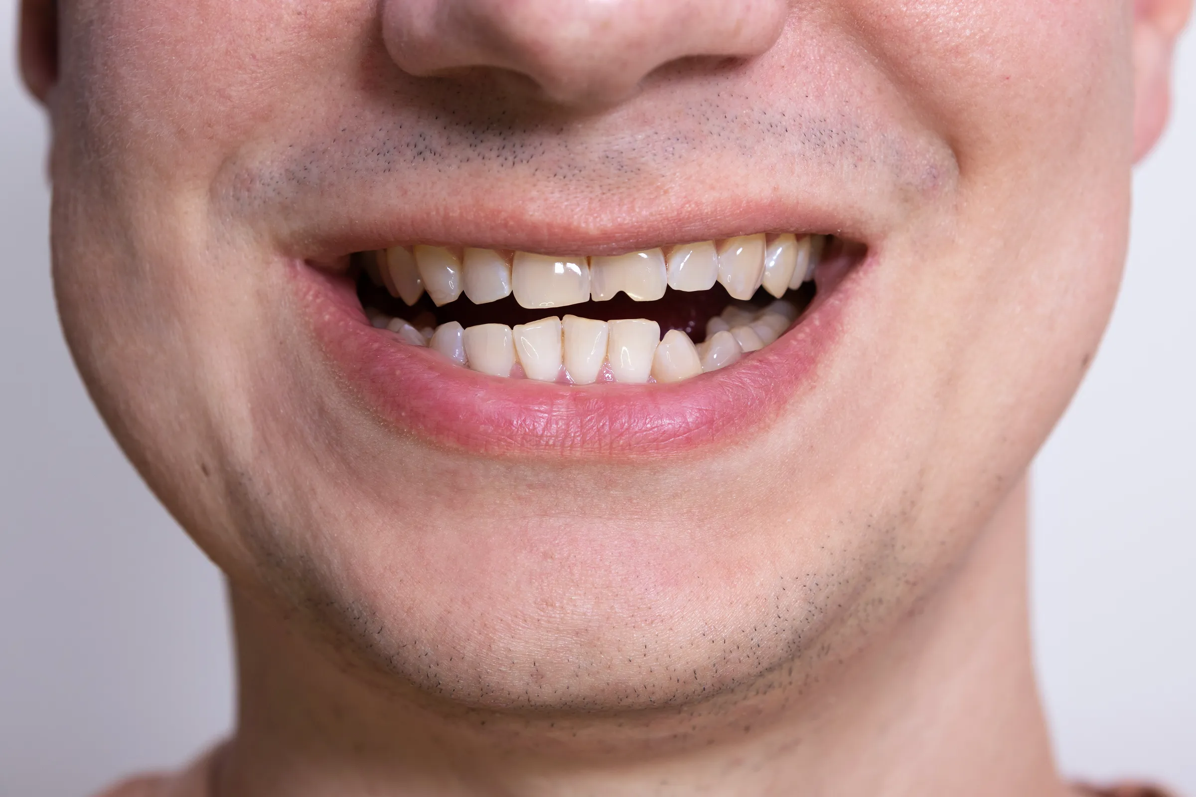 A close-up of a man’s smile with a chipped front tooth