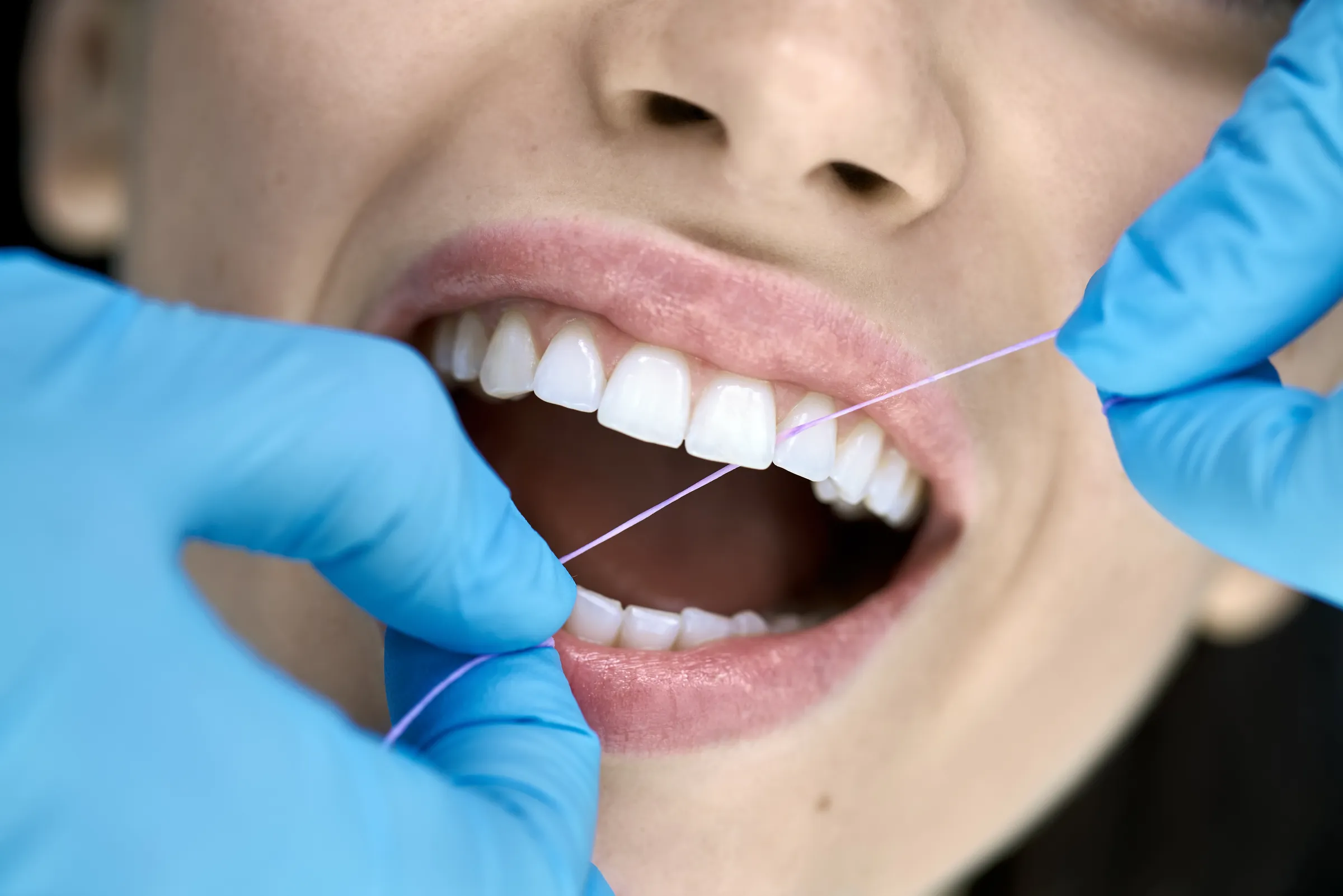 A hygienist flossing a patient’s teeth during a professional cleaning
