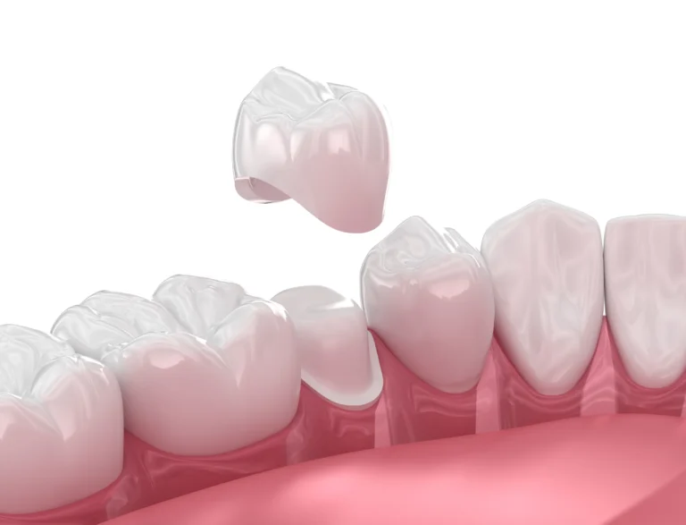 An illustration of a crown being lowered onto a prepared tooth in a row of teeth