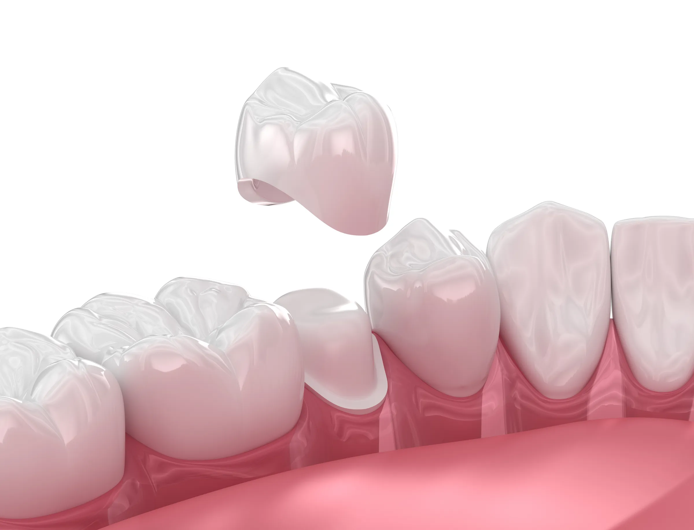 An illustration of a crown being lowered onto a prepared tooth in a row of teeth