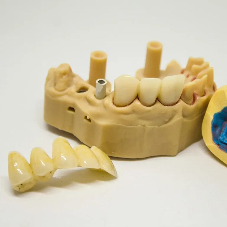 A dental bridge beside the prepared teeth on a model