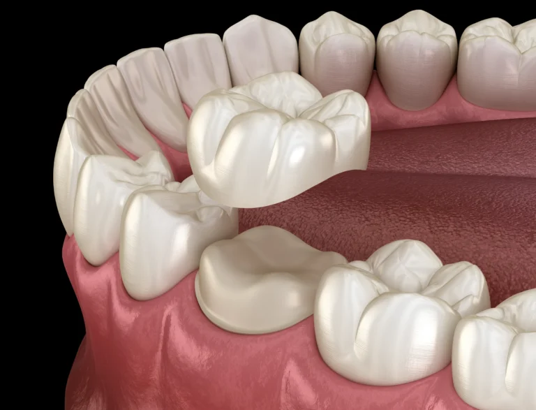 An illustration of dental crowns and a bridge being placed on prepared teeth