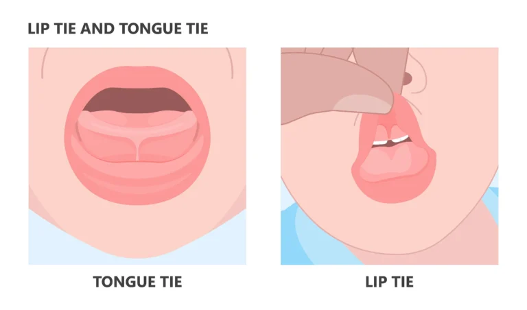 An illustration comparing a tongue tie and a lip tie