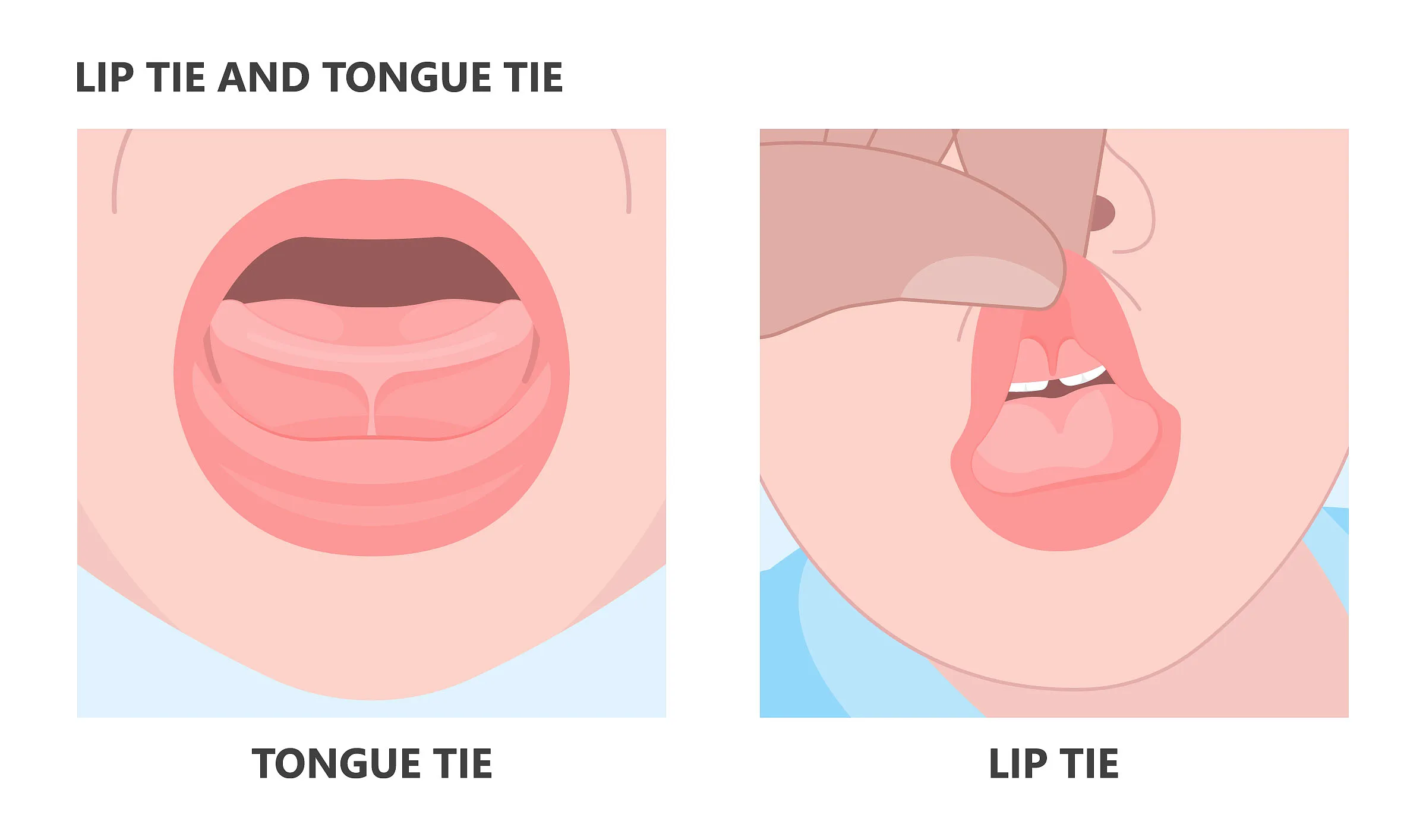 An illustration comparing a tongue tie and a lip tie