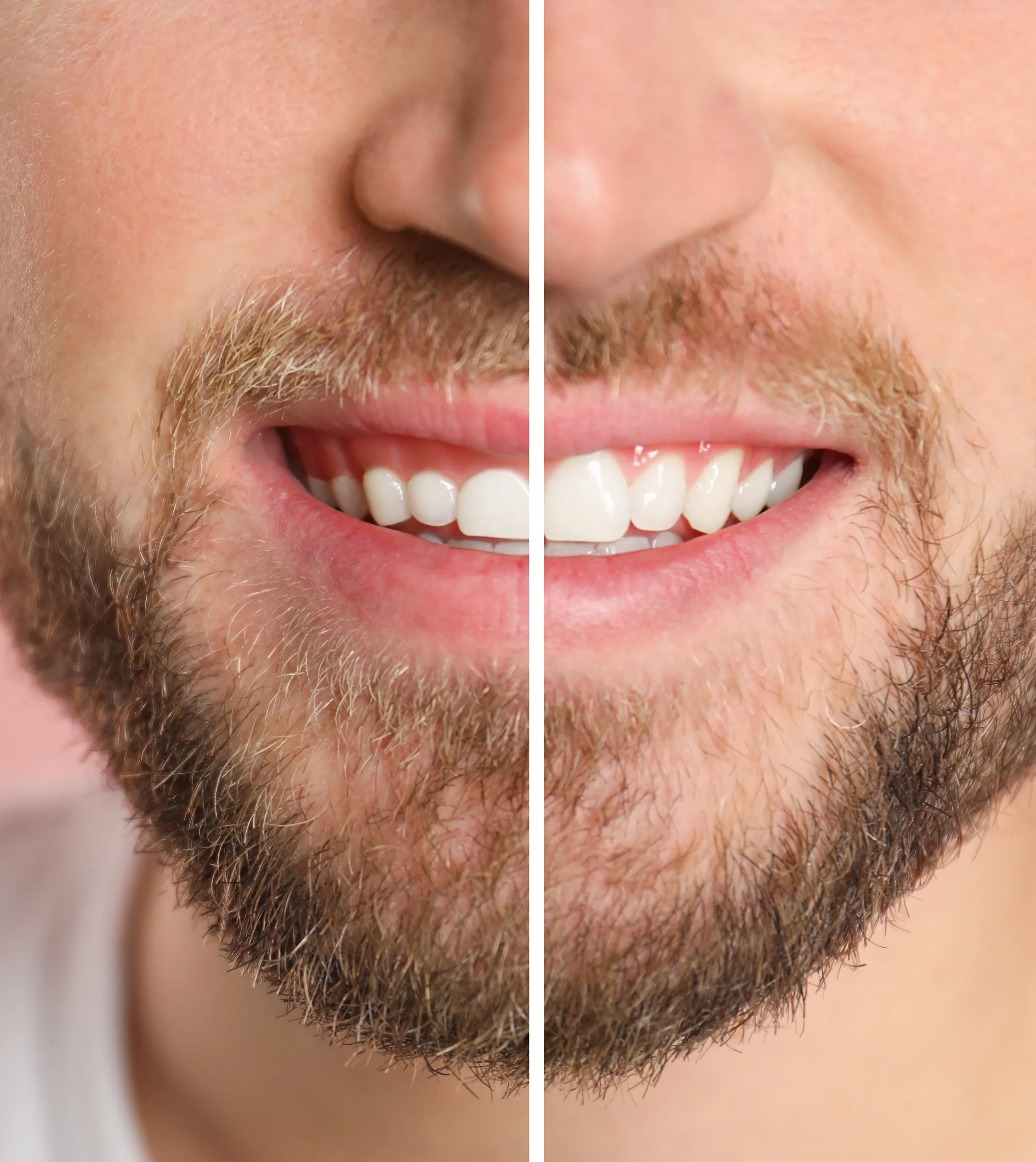 A man’s smile shown half before and half after gum contouring