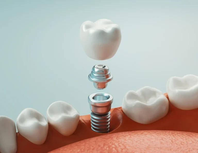An illustration of a single dental implant, abutment and crown