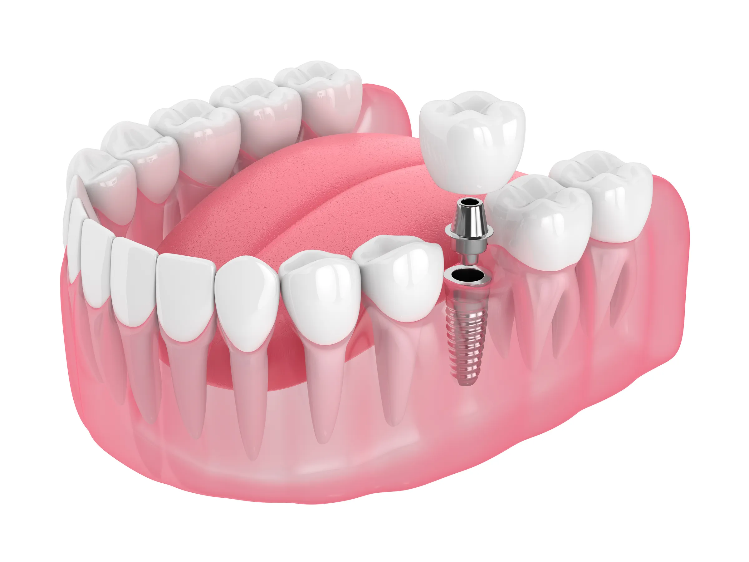 An illustration of a dental implant with a crown replacing one tooth