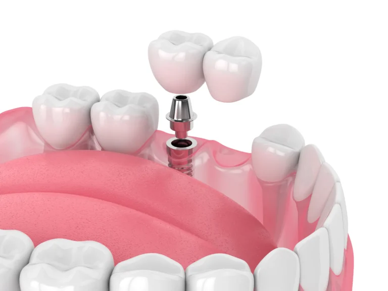An illustration of a dental bridge being placed on two implants