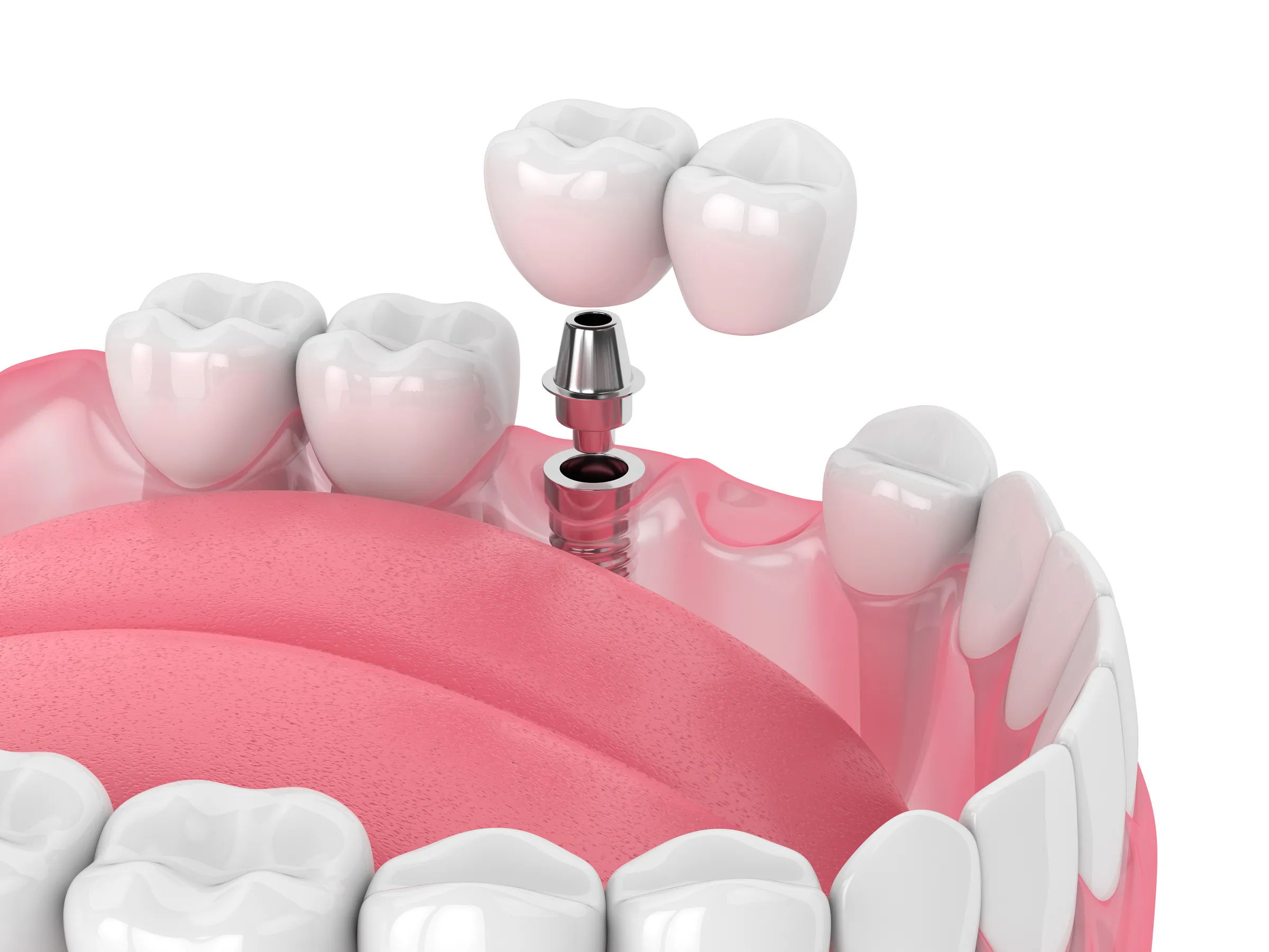 An illustration of a dental bridge being placed on two implants