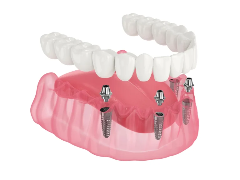 An illustration of a full denture that attaches to four implants
