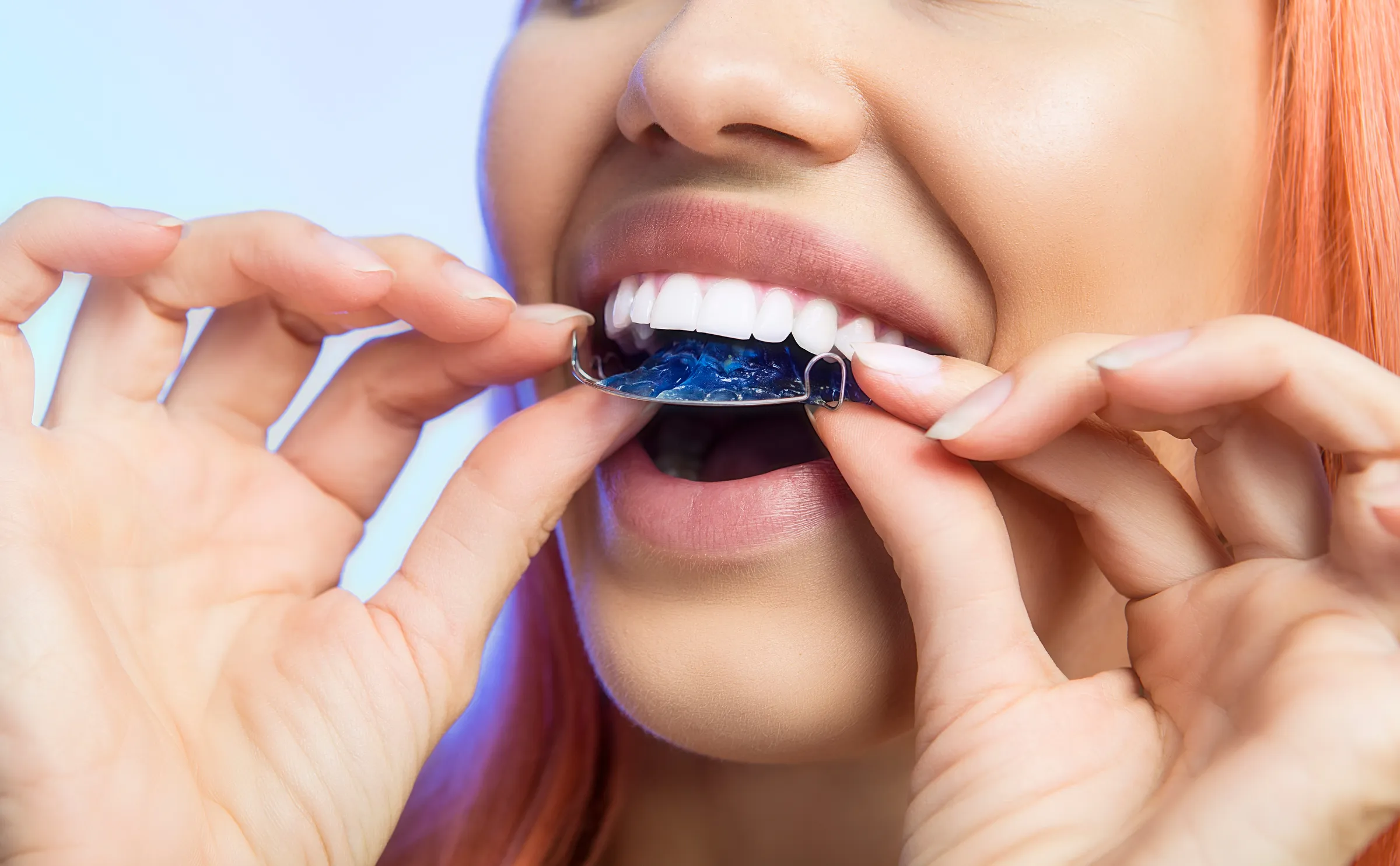 A woman placing a custom whitening tray over her teeth