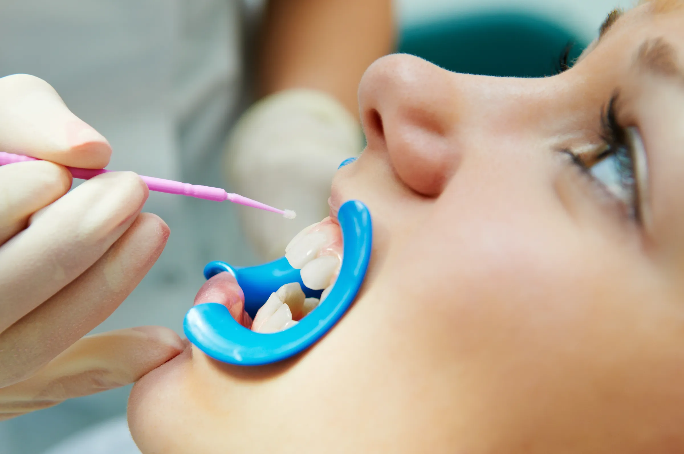 A dentist painting a protective sealant onto a back tooth