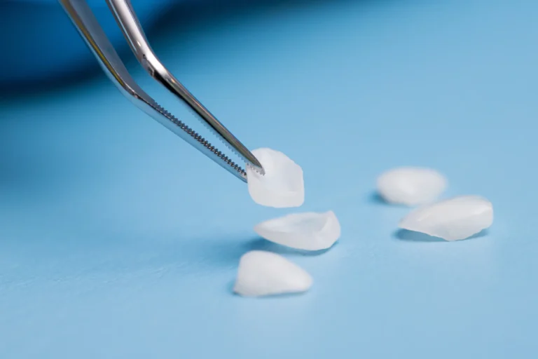 Thin porcelain veneers held in tweezers