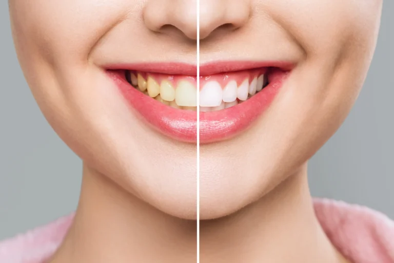 A smile shown half before and half after professional whitening
